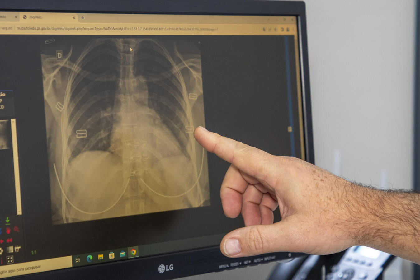 Medida tornará mais ágil atendimento a pacientes que necessitam do procedimento, que será agendado pela Central de Especialidades Osvaldo Luiz Ricci